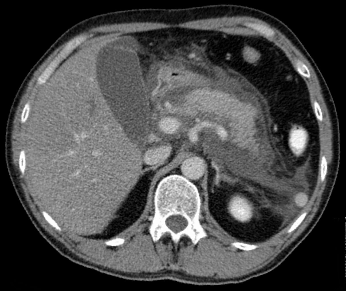 Axial CT scan showing acute exudative pancreatitis