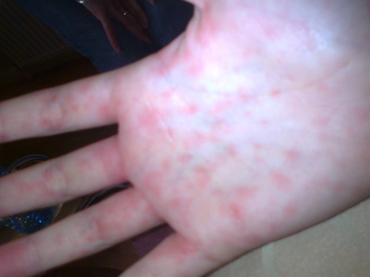 Maculopapular amoxicillin rash in a patient with infectious mononucleosis