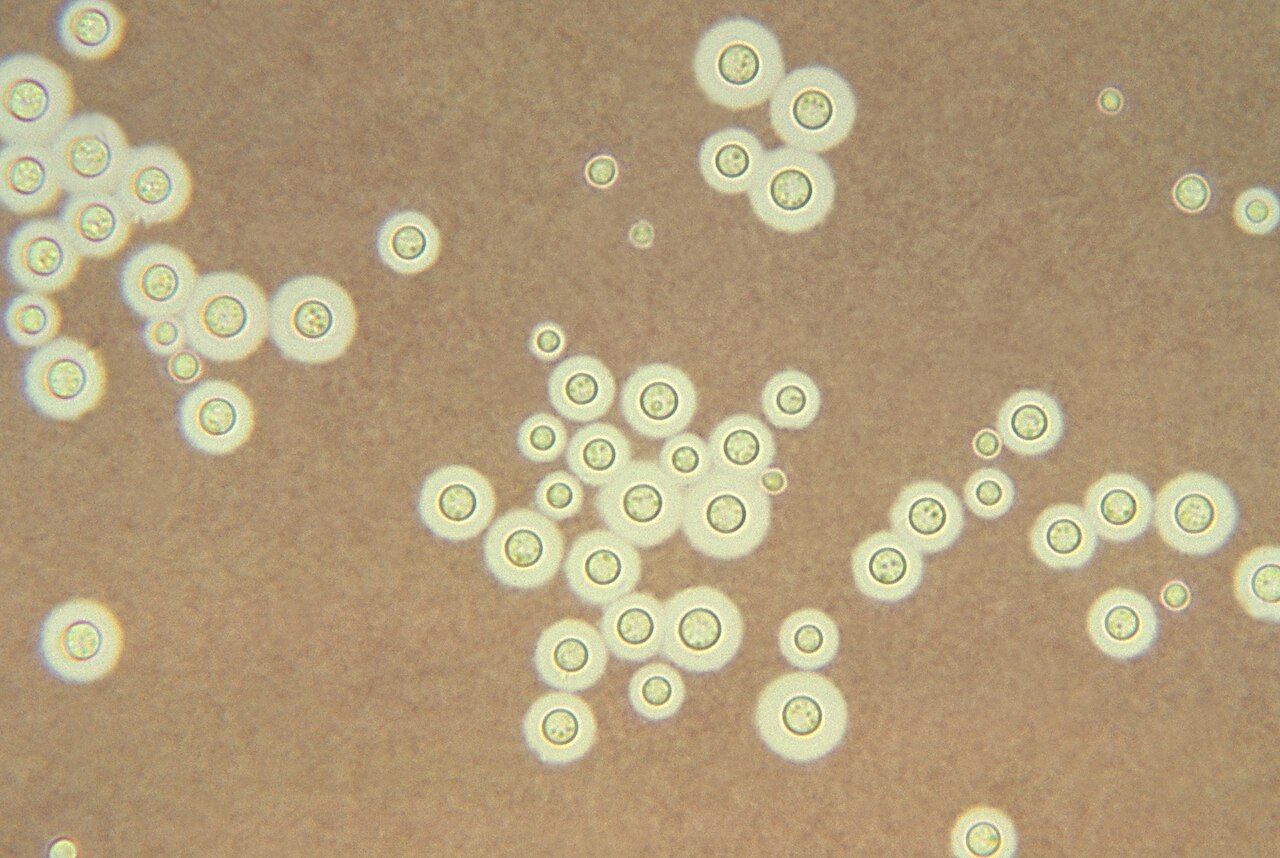 Encapsulated Cryptococcus neoformans yeast on India ink stain